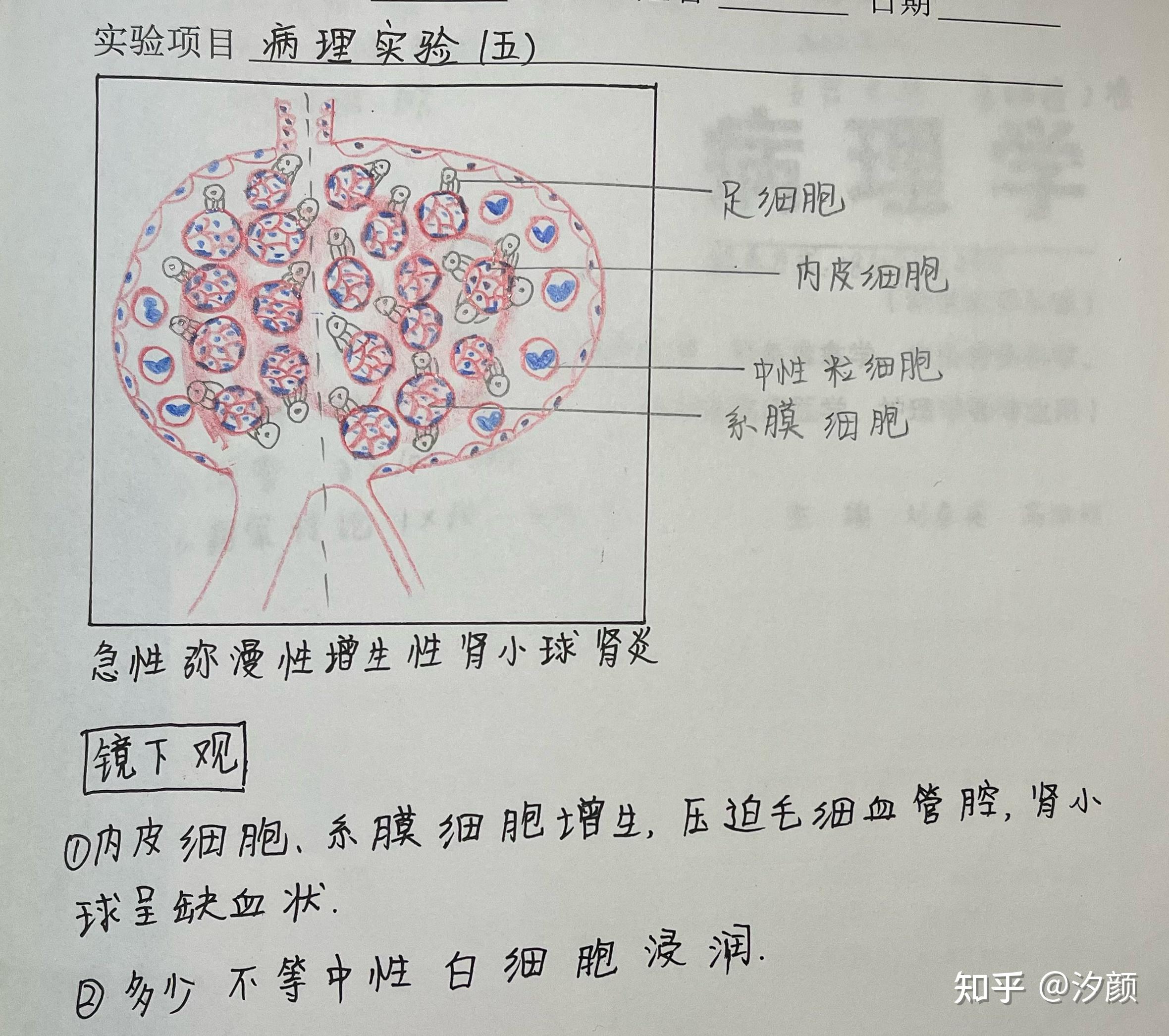 慢性肾炎红蓝铅笔绘图图片