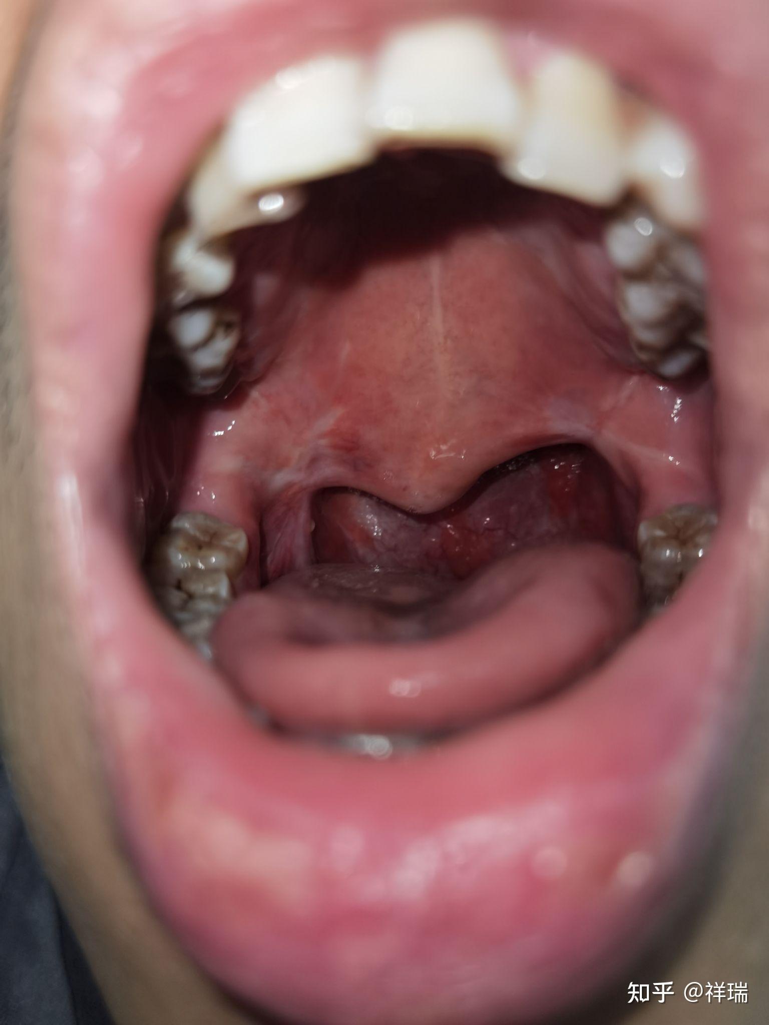 呼吸暂停综合征鼾症手手术毁了我一生