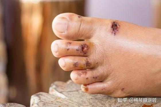 干细胞在糖尿病皮肤溃疡中的2个应用研究