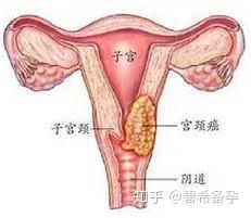 关于子宫的二三事 知乎