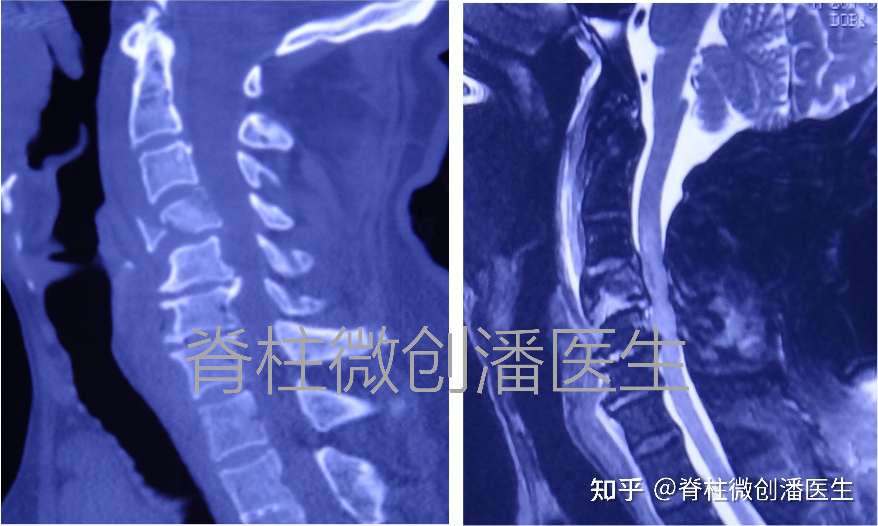 如何判断颈椎外伤后的瘫痪是否能恢复以及恢复程度? - 知乎
