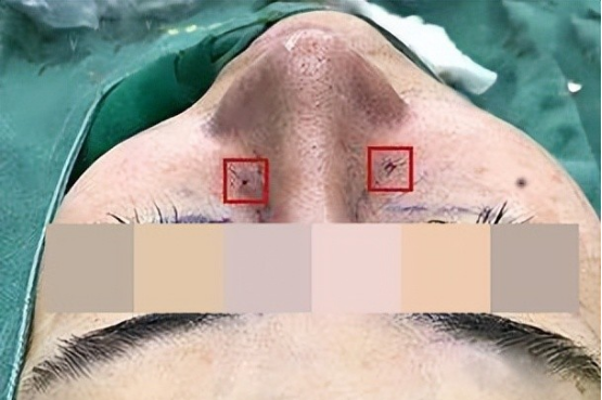 有什么风险和后遗症?如何选择擅长鼻骨内推手术的医院医生?