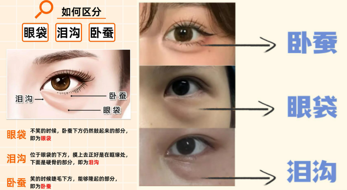 眼底俩“大水泡”是不是眼袋?不想动刀怎么去眼袋?有没有成功上岸的来说一下? - 知乎