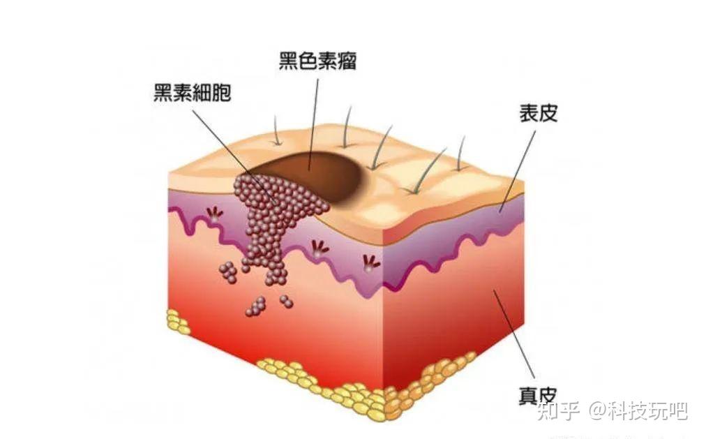 黑色素瘤是黑色素细胞恶变而来的肿瘤,简称恶黑,是常见的皮肤癌之一