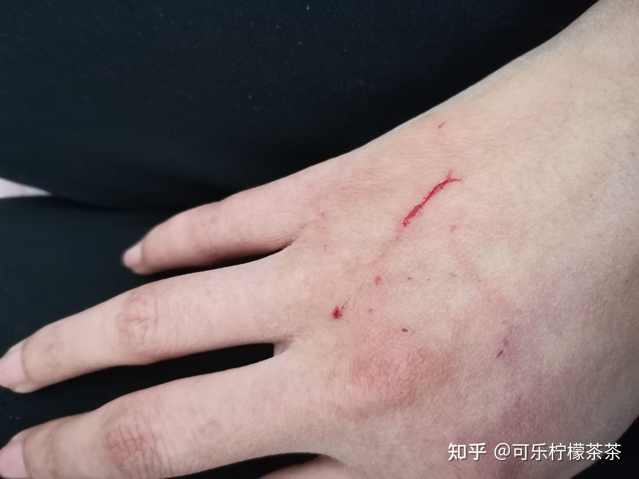 猫抓伤的伤口特点图片图片