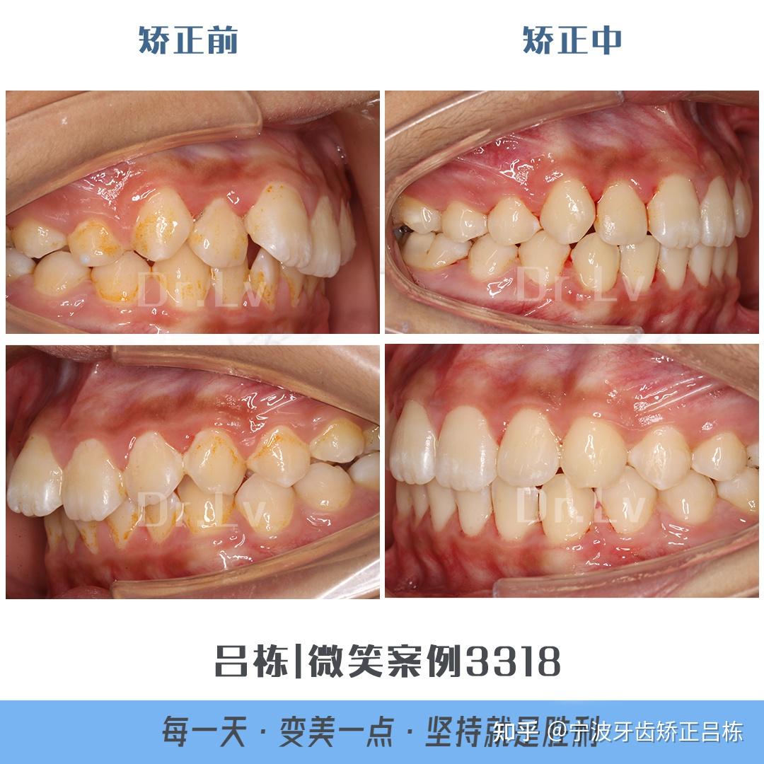 寧波牙齒矯正圍觀牙齒正畸到底帶來的變化