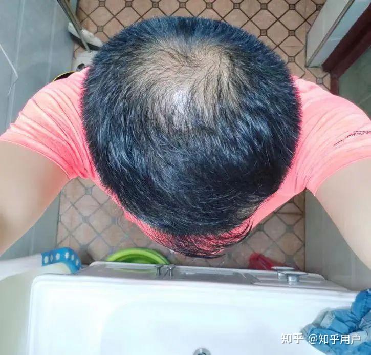 【实时热点】6年脱发患者首次分享养发秘籍!满头炸的碎发竟靠的是它! - 知乎