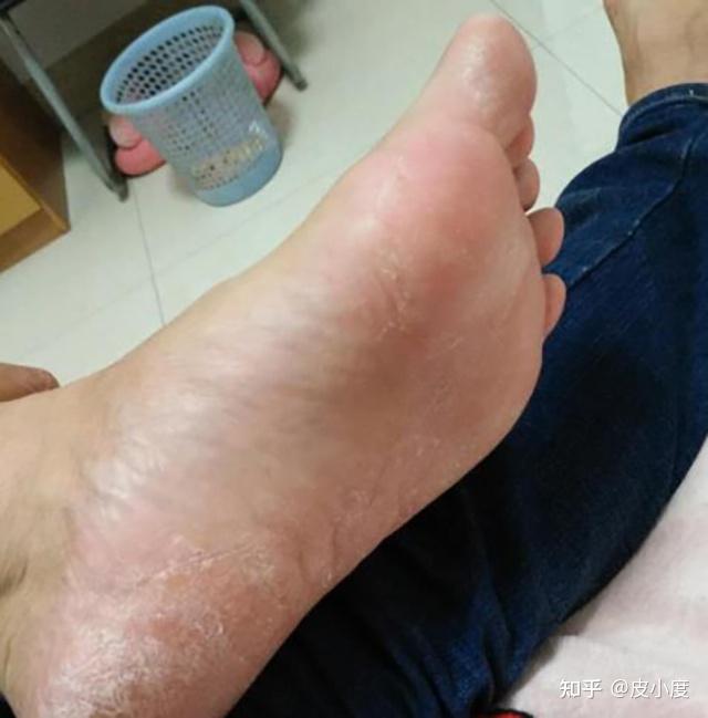 男子脚气又因闻臭袜子致肺部真菌感染