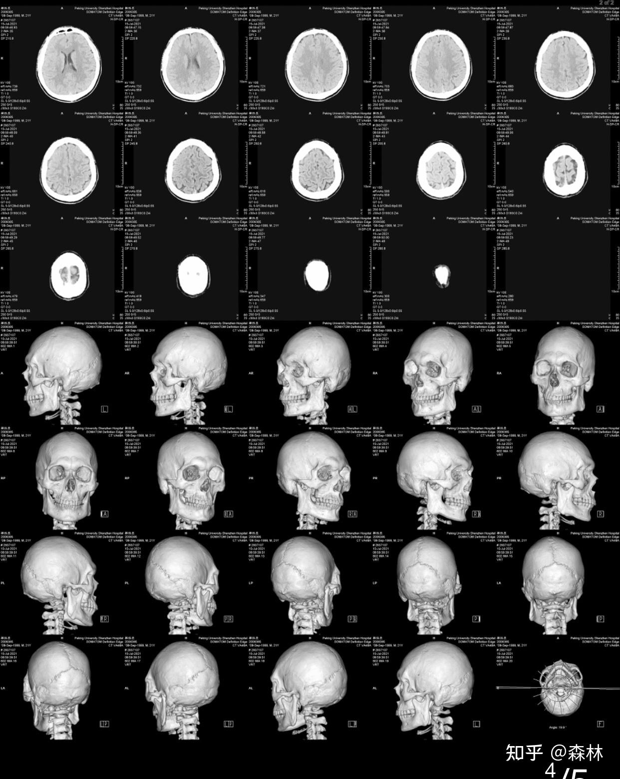 这是我还没手术前的ct,这样就可以看出来下颌骨很肥大还不对称,现在不