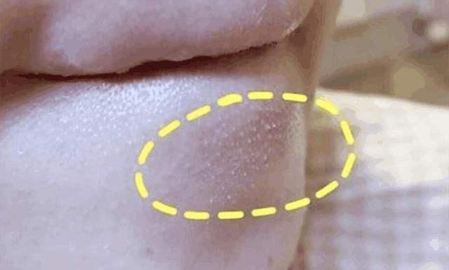 抿嘴时下巴出现的小颗粒究竟是啥?听clever skin妙肤秀给你解答
