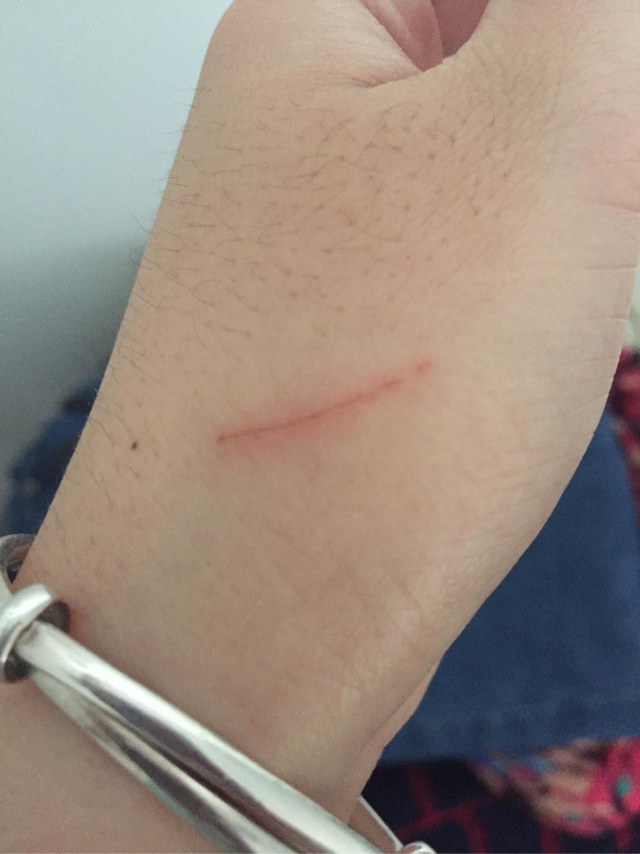 前几天被自家狗抓伤今天发现已经结痂了狗狗一直有打针请问我需要去