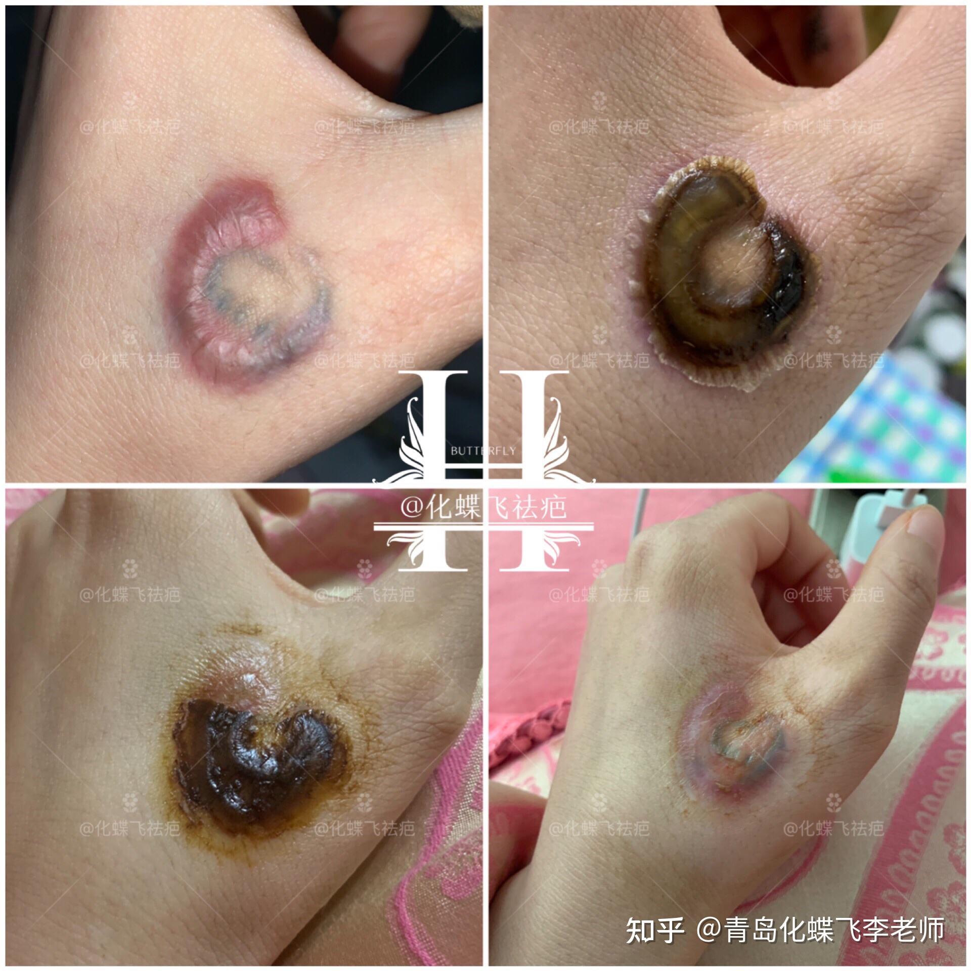 洗纹身以后,出现了疤痕增生怎么办?
