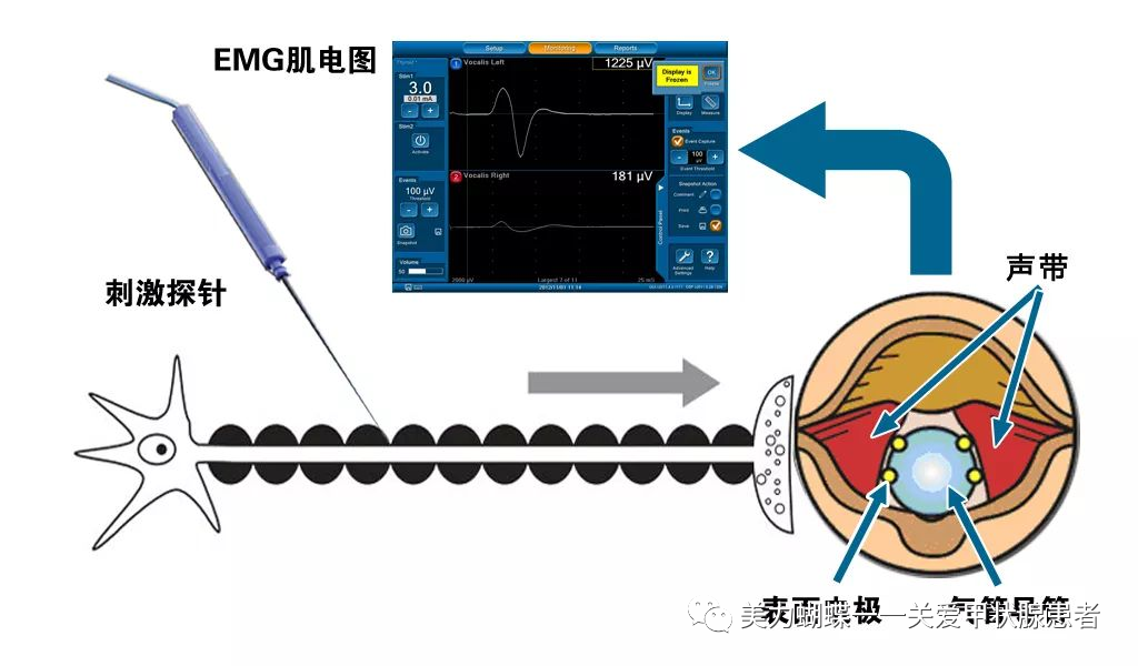 神经检测在甲状腺手术中的应用