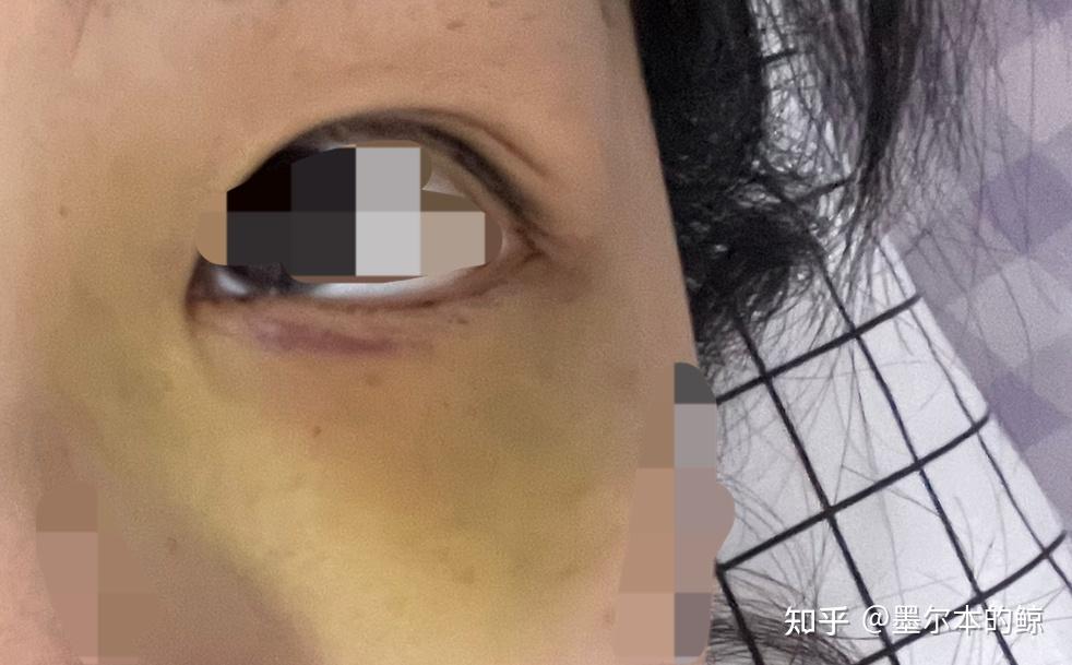 关于慢性泪囊炎的心路历程🥱 - 知乎