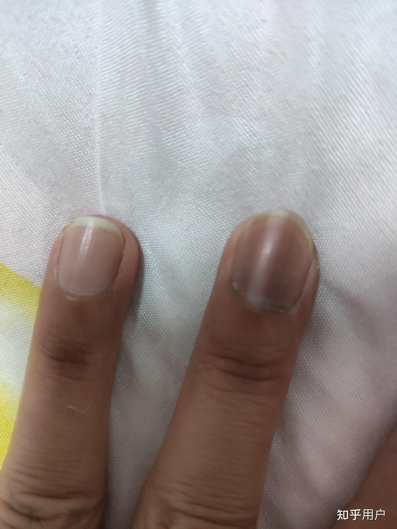 左手大拇指指甲有一条淡褐色竖线好几年了微量元素也正常为什么啊