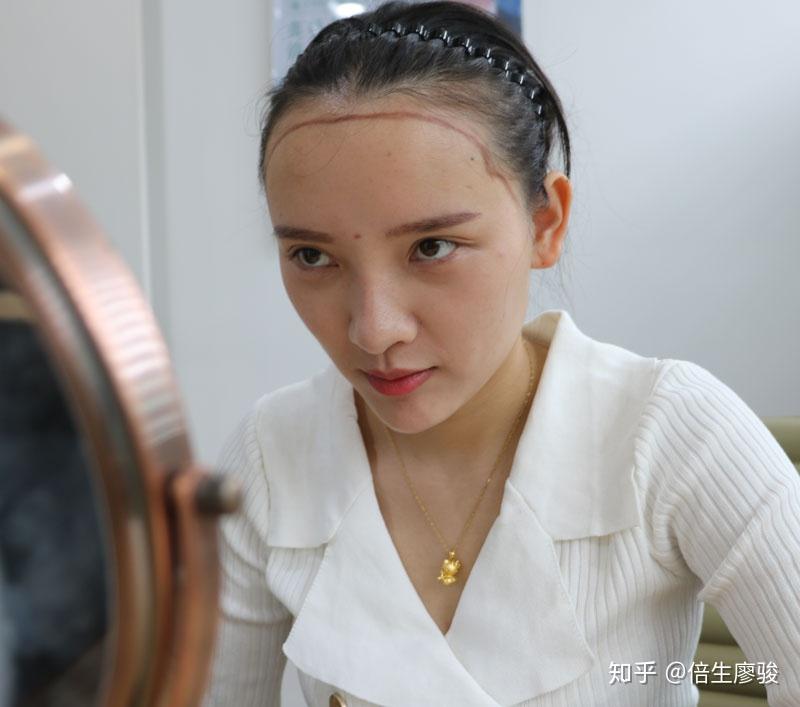 女性发际线后移影响颜值植发恢复全记录