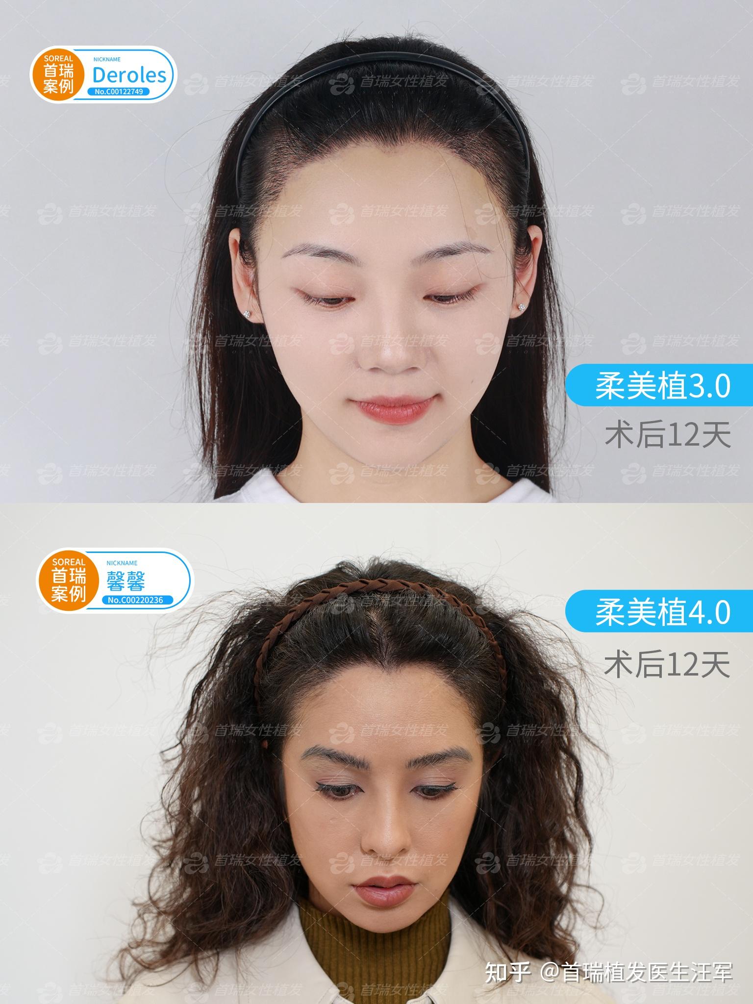 柔美植:专为女性定制的发际线修复技术,精准自然,术后恢复快