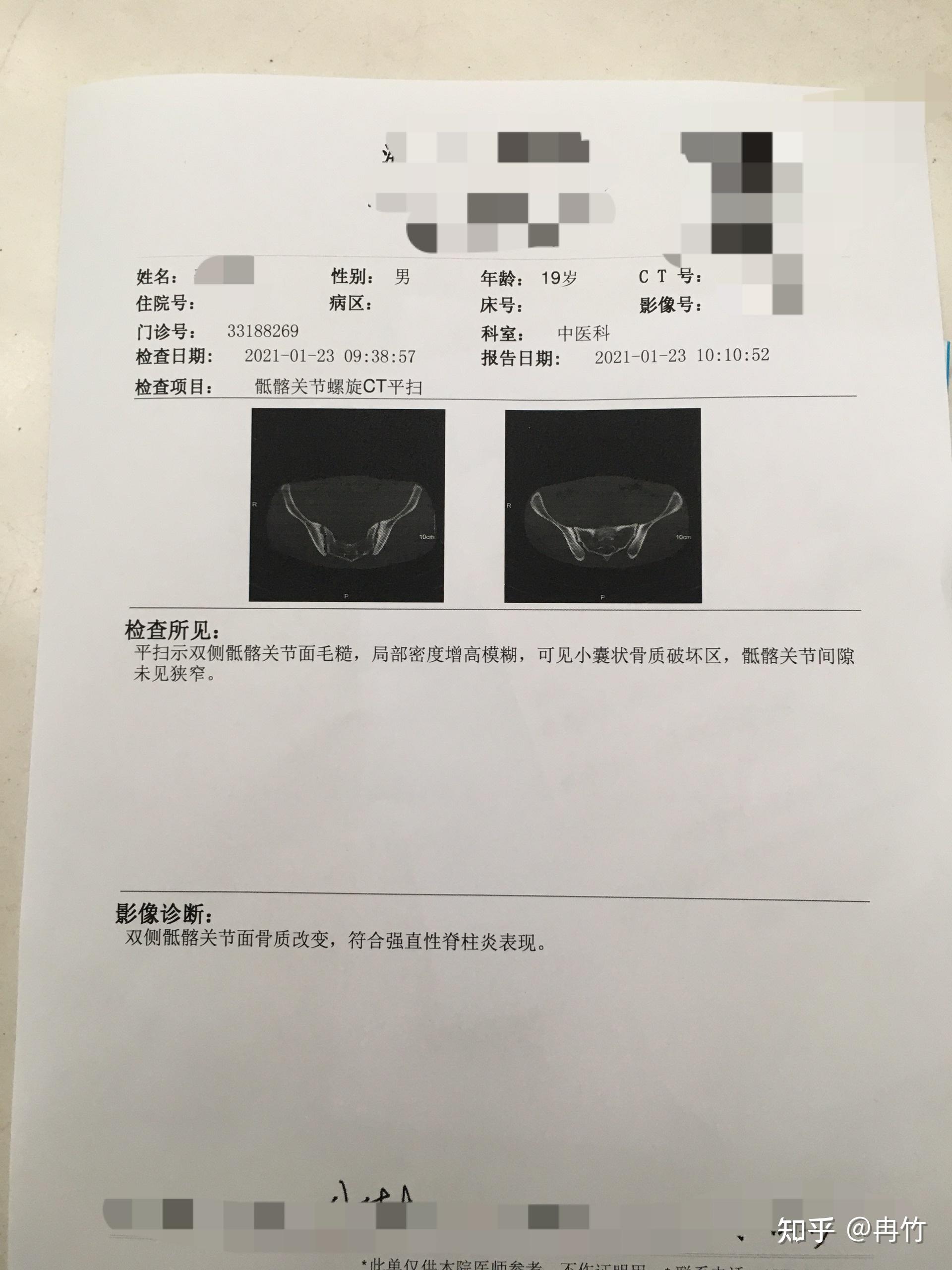 前几天,我在查找强直性脊柱炎,找到了一篇文章