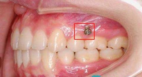 牙医涛哥隐适美全球认证黑钻医生