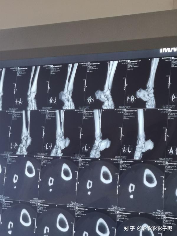 小腿腓骨骨折严重吗 腓骨骨折10天就上班 腓骨骨折为什么不需要治疗
