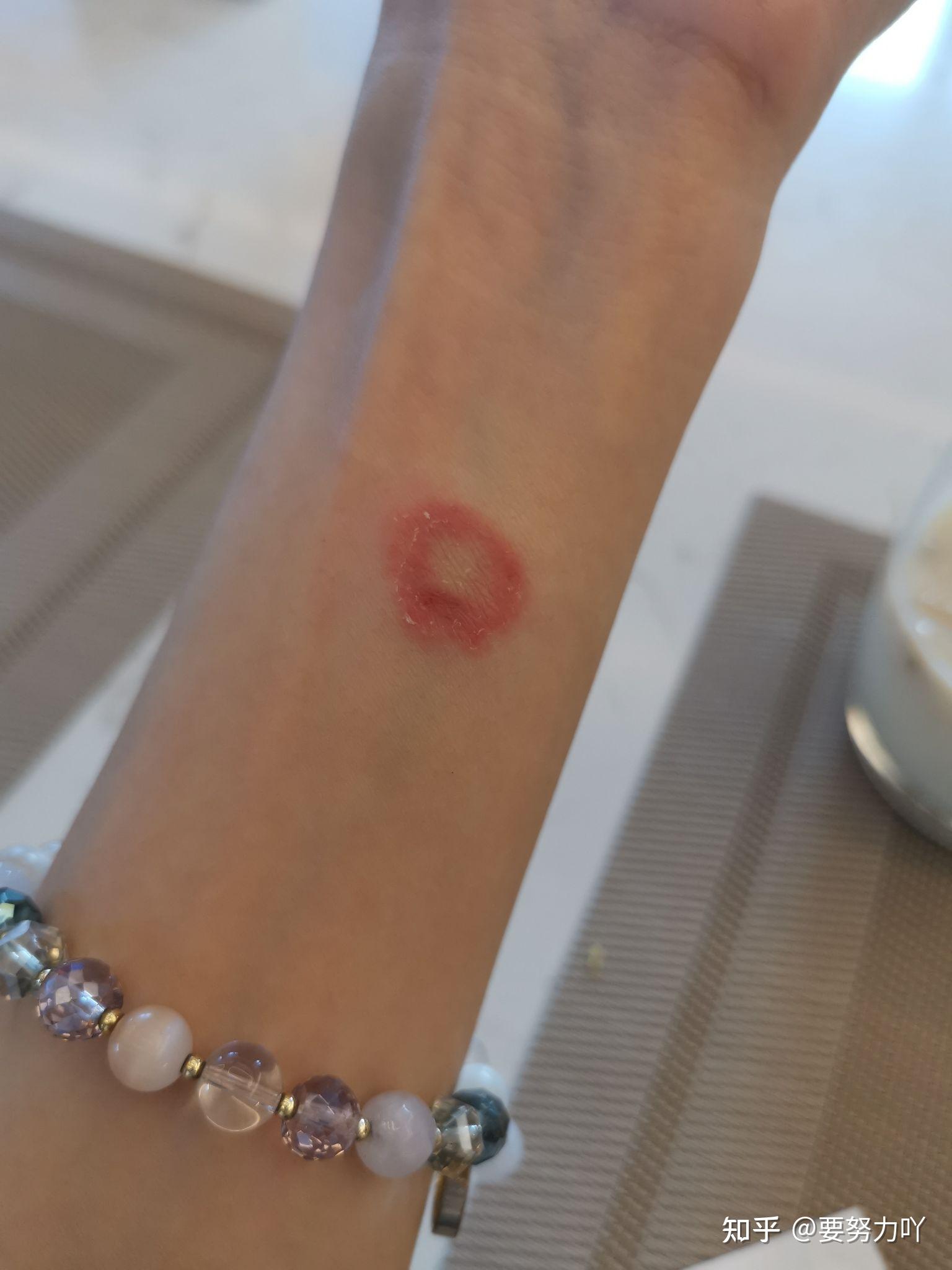 人的猫癣早期到底是什么样? - 知乎