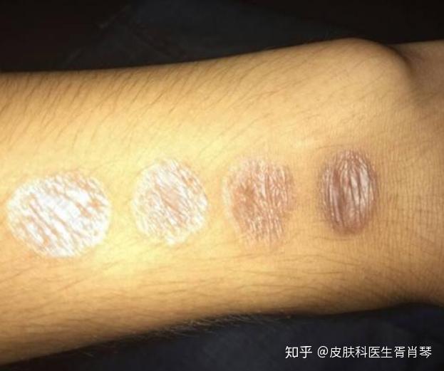 胥肖琴医生讲解：身上留下的烟疤怎么去除？ - 知乎