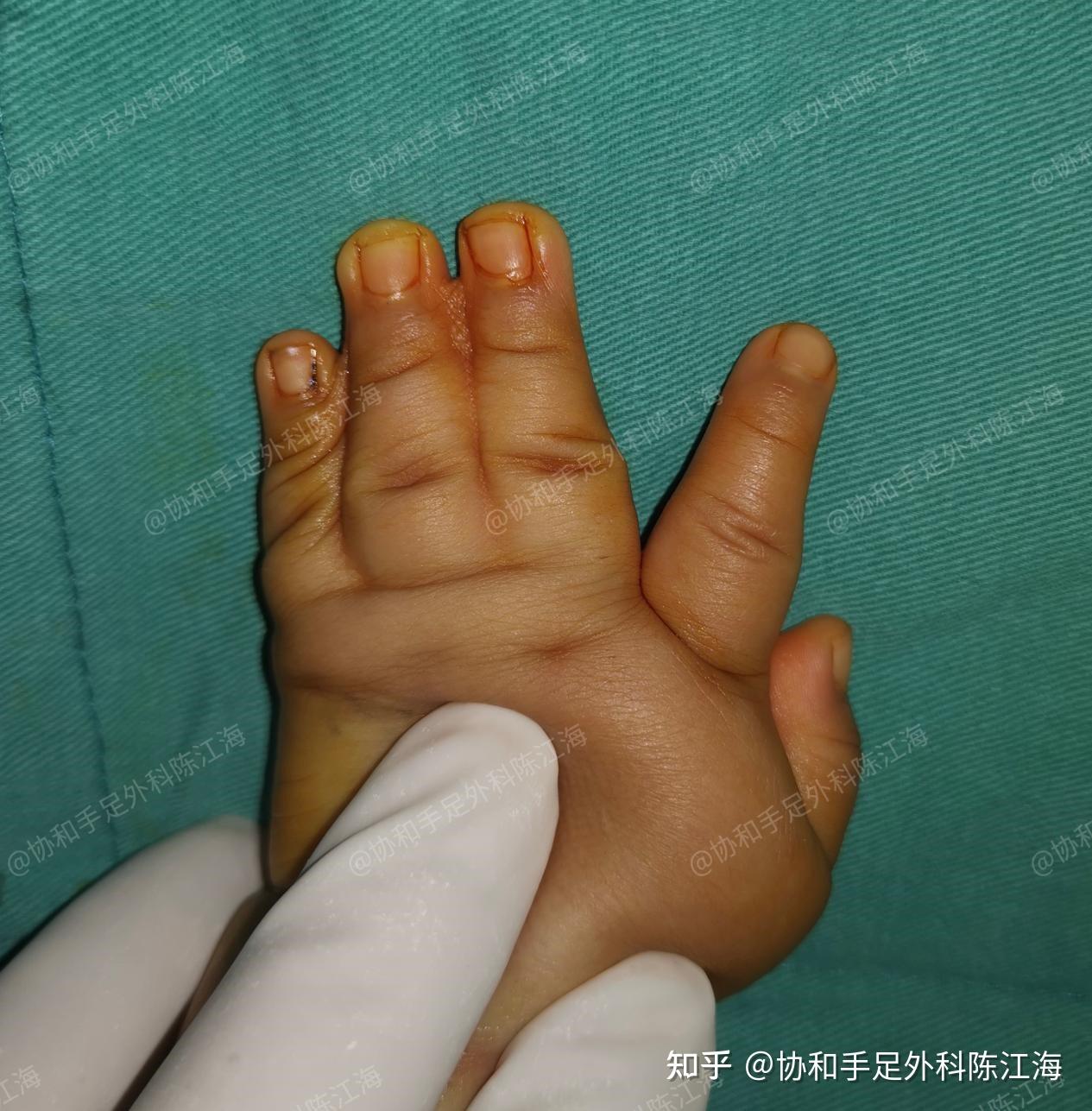 并指免植皮 | 案例11《双手并指一次分完,宝宝有了灵活的双手 - 知乎