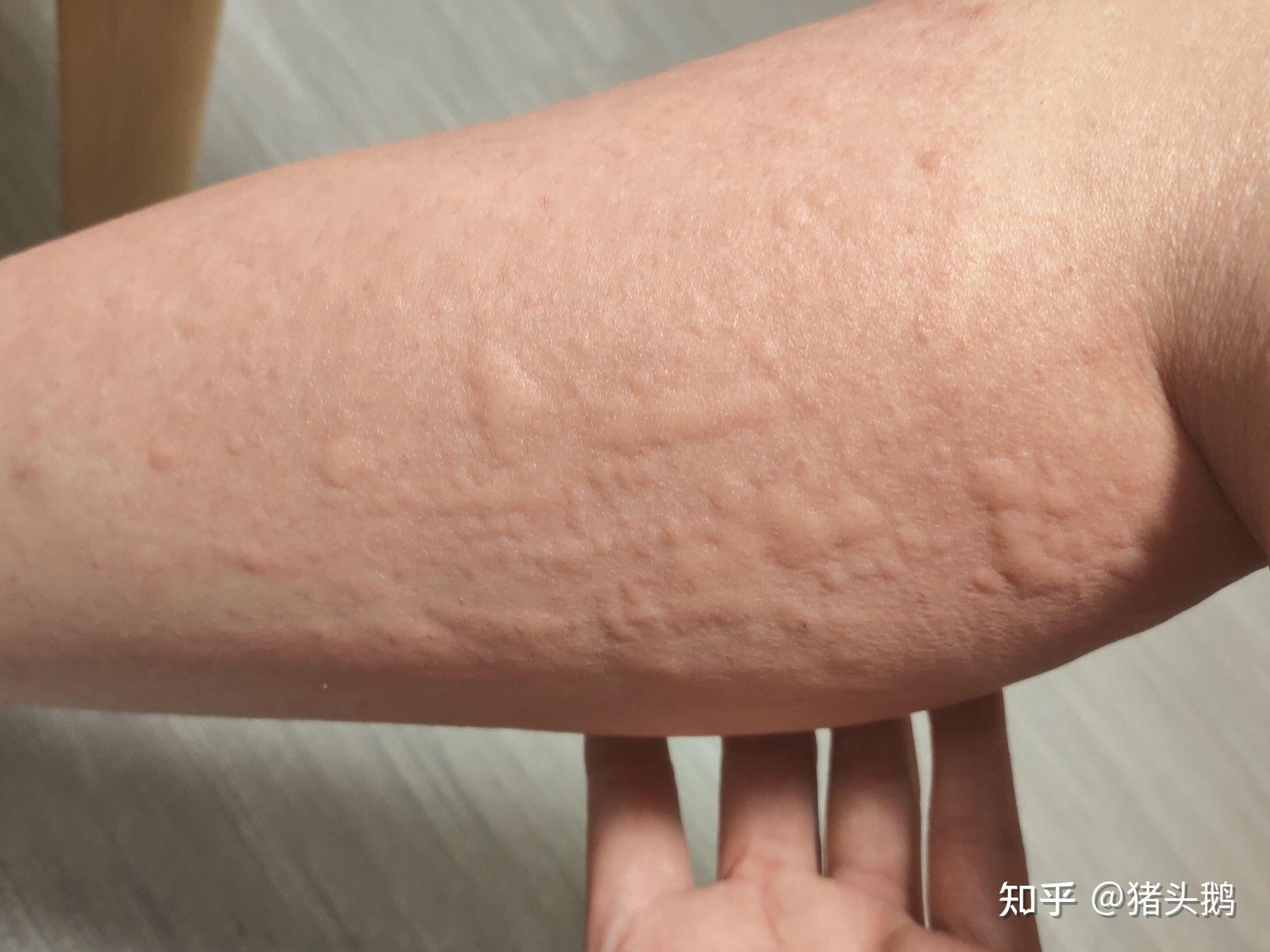 记~正在发生的讨厌荨麻疹 - 知乎