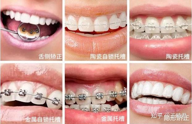 不同的牙齿矫正方式价格有什么区别?如何选择靠谱的牙齿正畸医生?