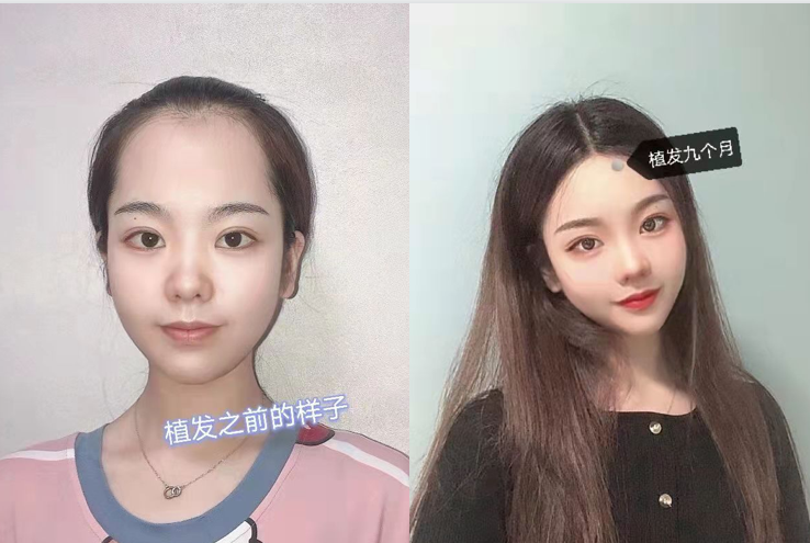 发际线有多影响女生的面部轮廓花瓣发际线m发际线圆形发际线该怎么选