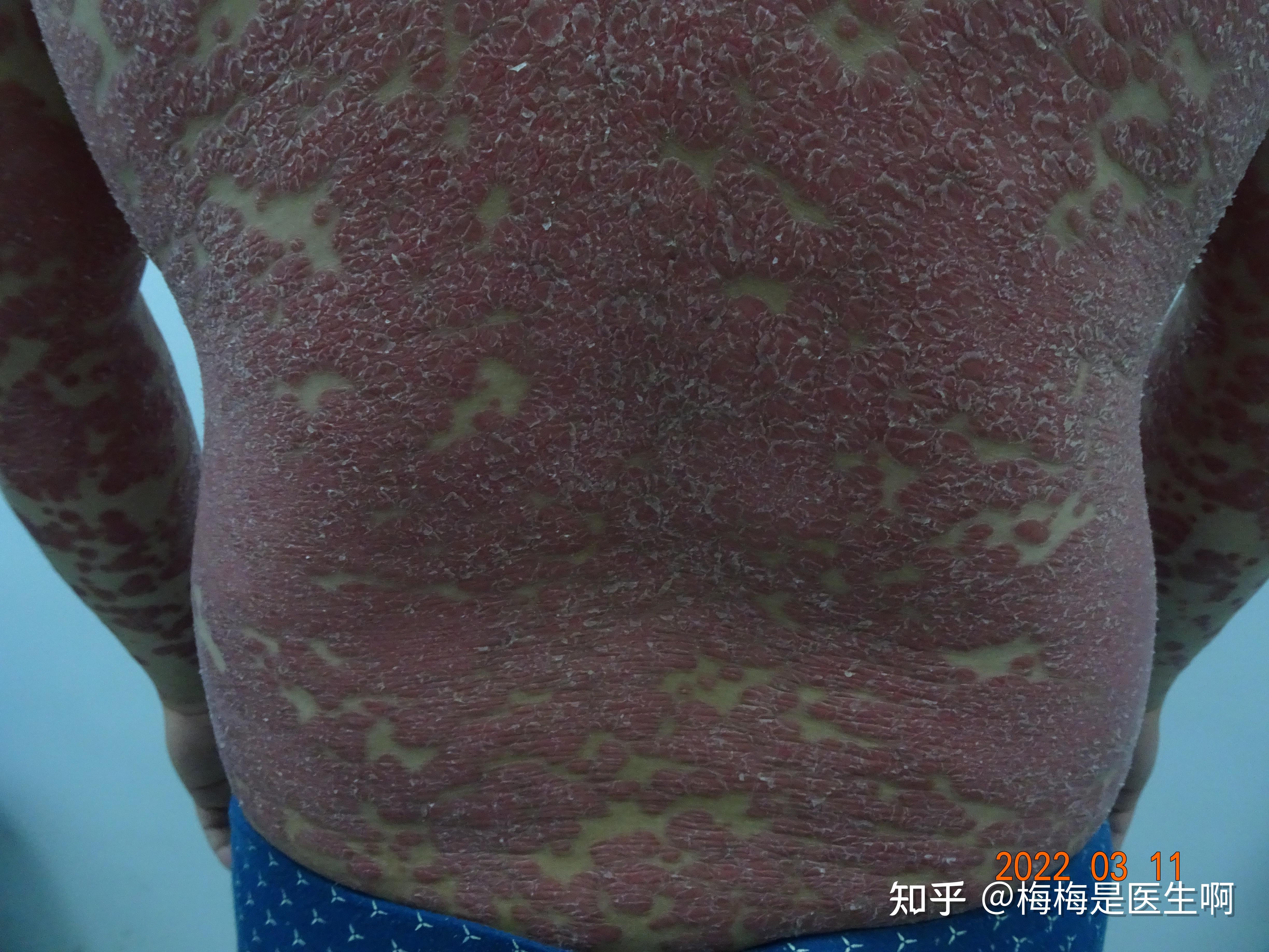 一个男孩出国旅游后,皮肤变化让护士倒吸一口冷气 | 全身银屑病