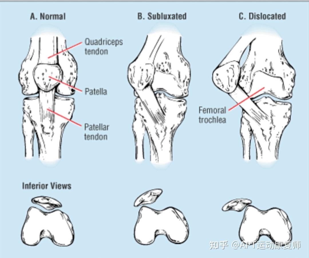 髌骨脱位示意图图片