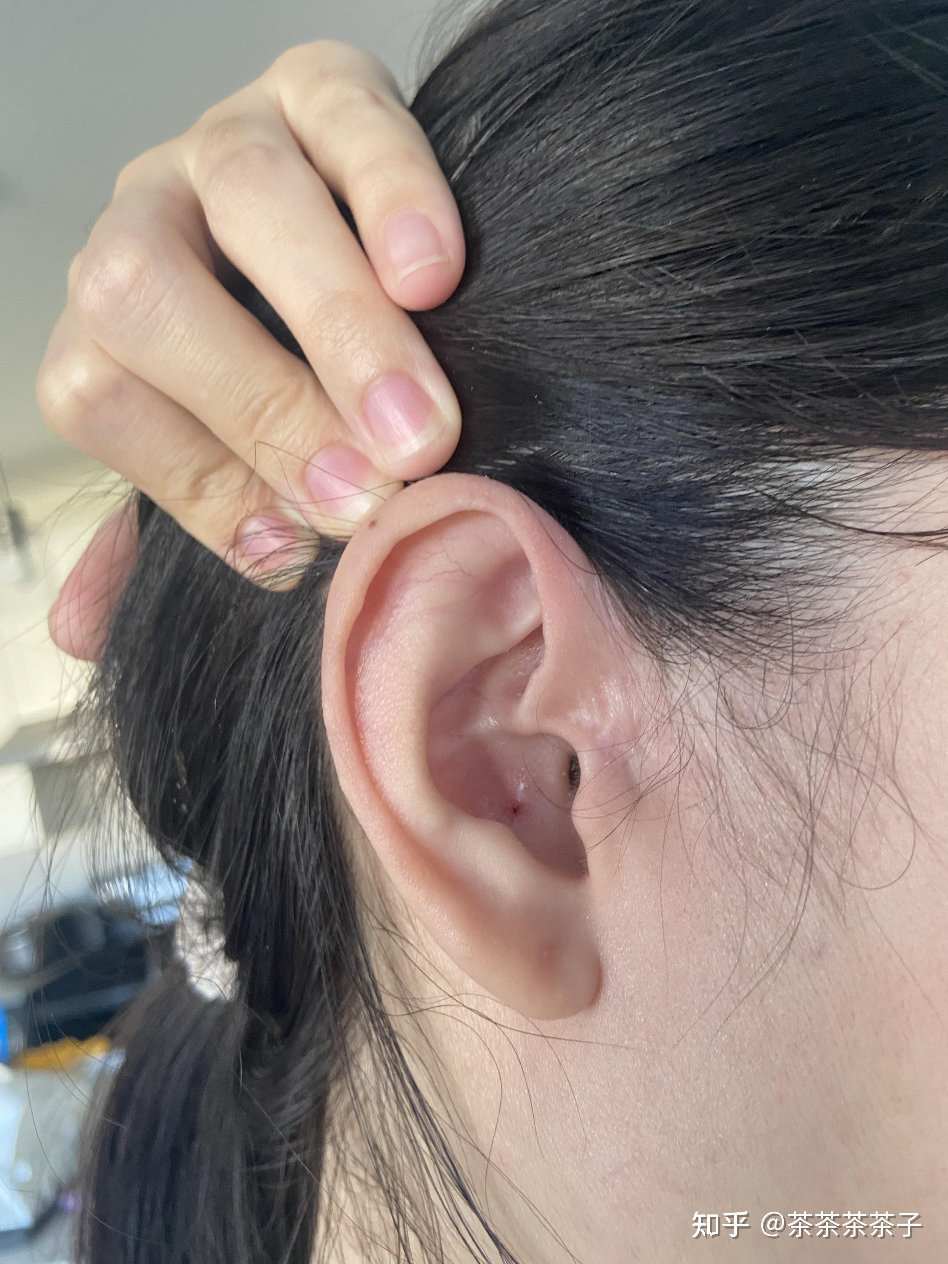 耳前瘘管手术治疗全过程 