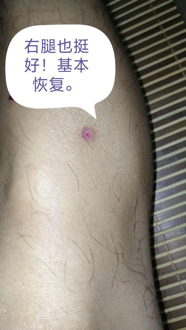 足三里瘢痕灸,酸爽得不得了! - 知乎