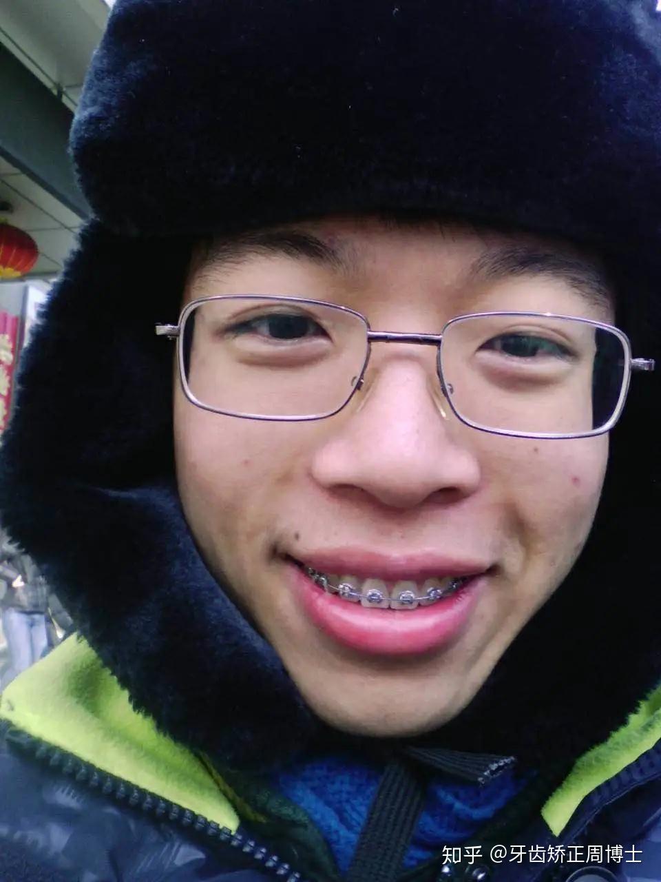 牙套日记突嘴男孩二次矫正终于告别香肠嘴