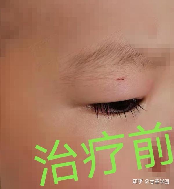 甘草学园 | 小孩麦粒肿该怎么治疗？分享一例病案 - 知乎