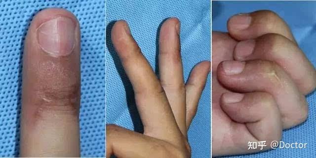槌状指不是难处理的手指伤害,配合支具穿戴是治疗的重要指标,早期治疗