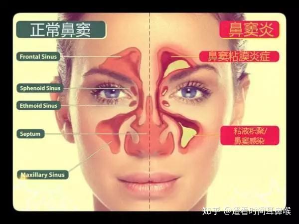鼻窦炎的相关知识 - 知乎