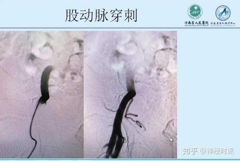 位置:腹股沟韧带下方l-2cm,30-45度夹角股动脉穿刺更为安全穿刺动脉