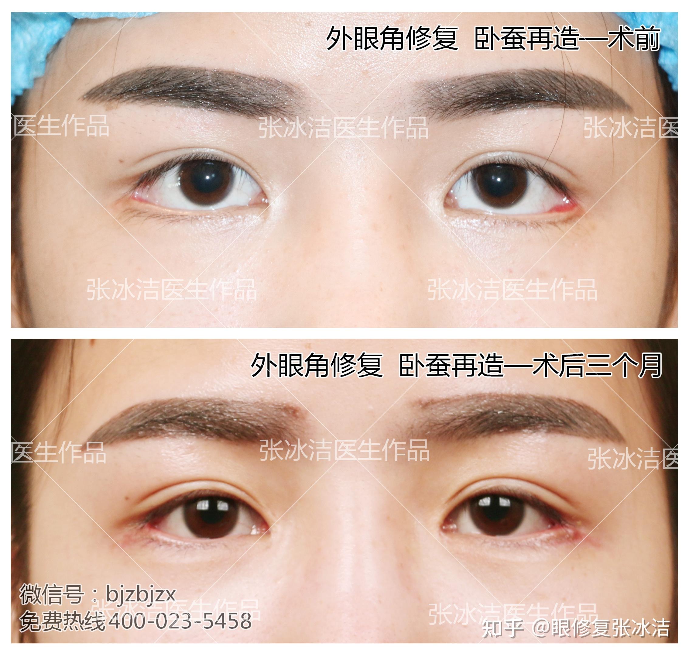 张冰洁谈下睑外翻修复丨真皮卧蚕在下睑外翻中应用