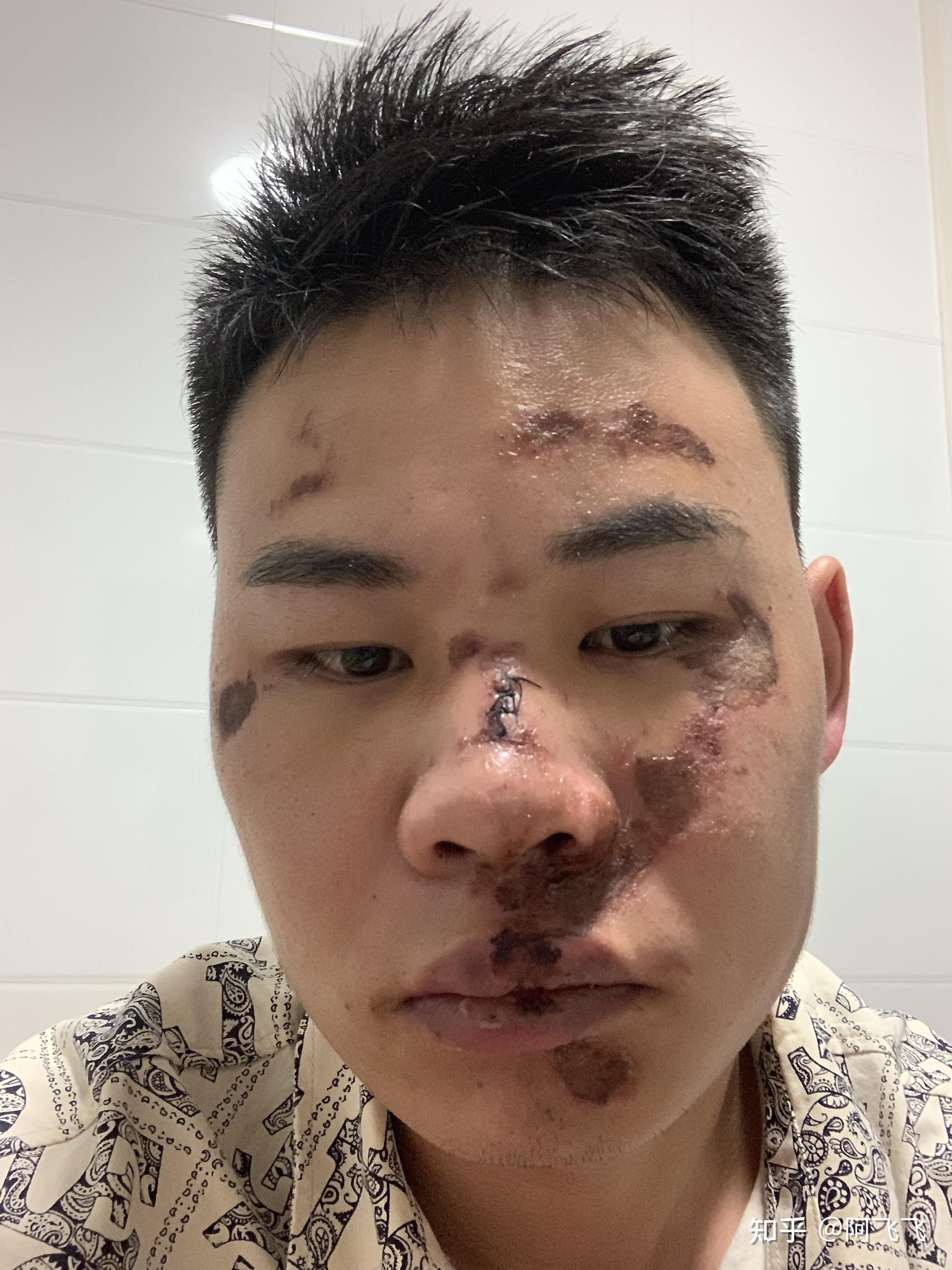 骑车摔跤面部大面积擦伤怎么办