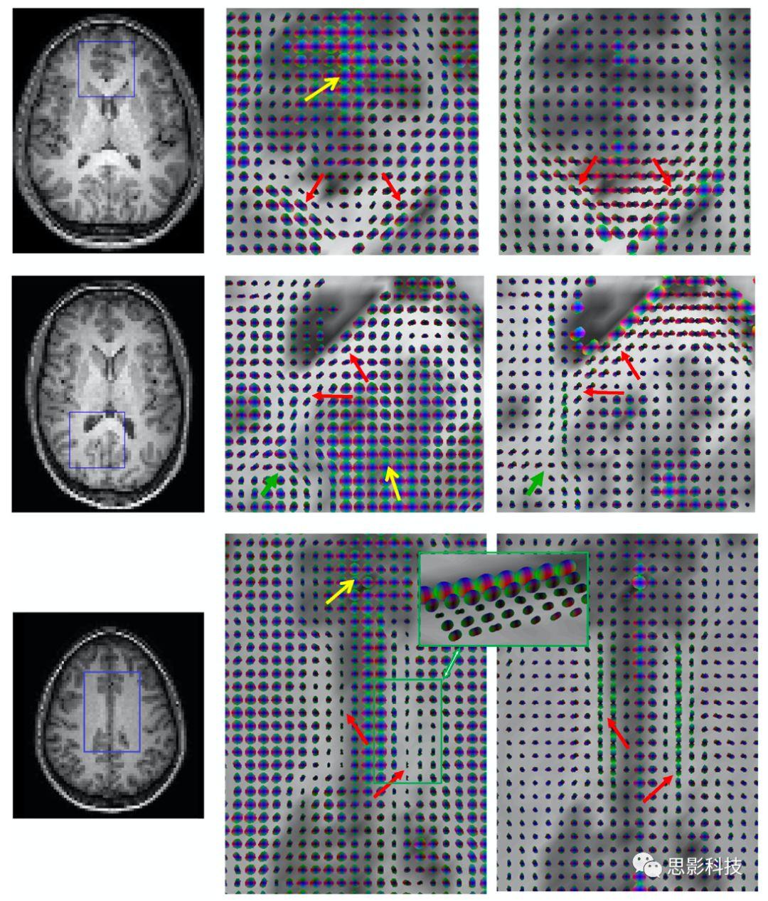 Magnetic Resonance Imaging:白质fMRI及静息态功能连接 - 知乎