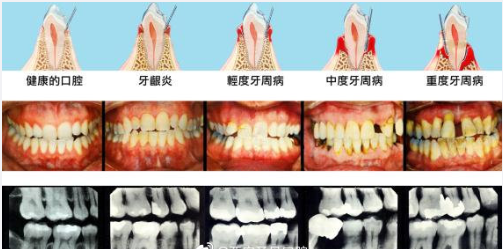 什么是牙周病及症状表现 v2-fa7cc1687fc653909ac5bf026a0fe60e_1200x500.jpg