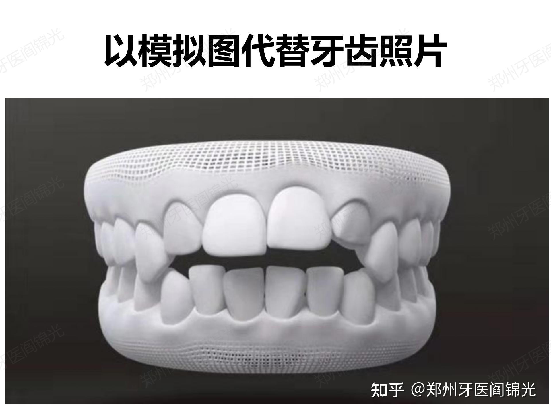 中年女性凸面形伴前牙重度开合中度牙周炎的固定矫治设计 - 知乎