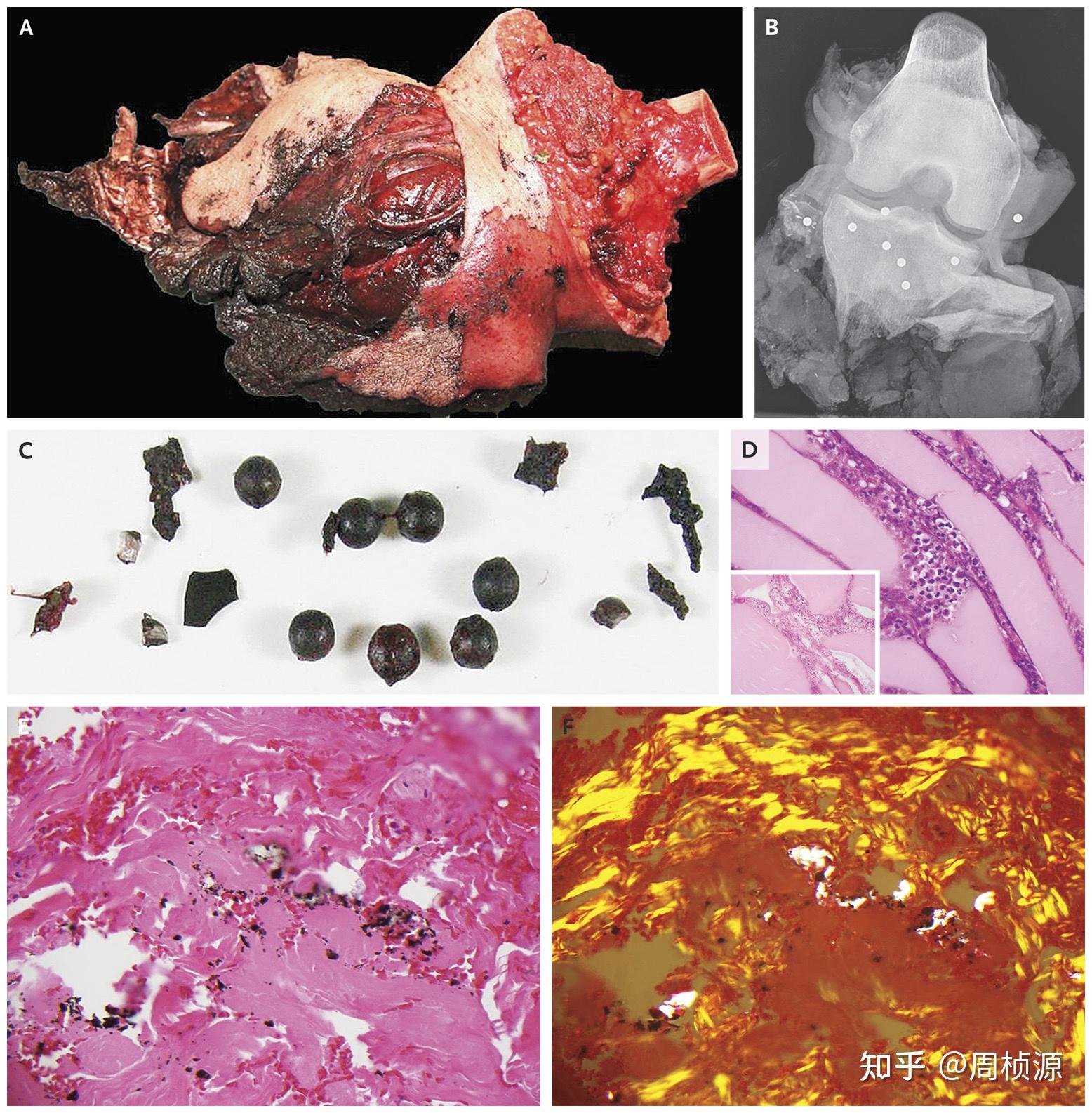 nejm2014case11