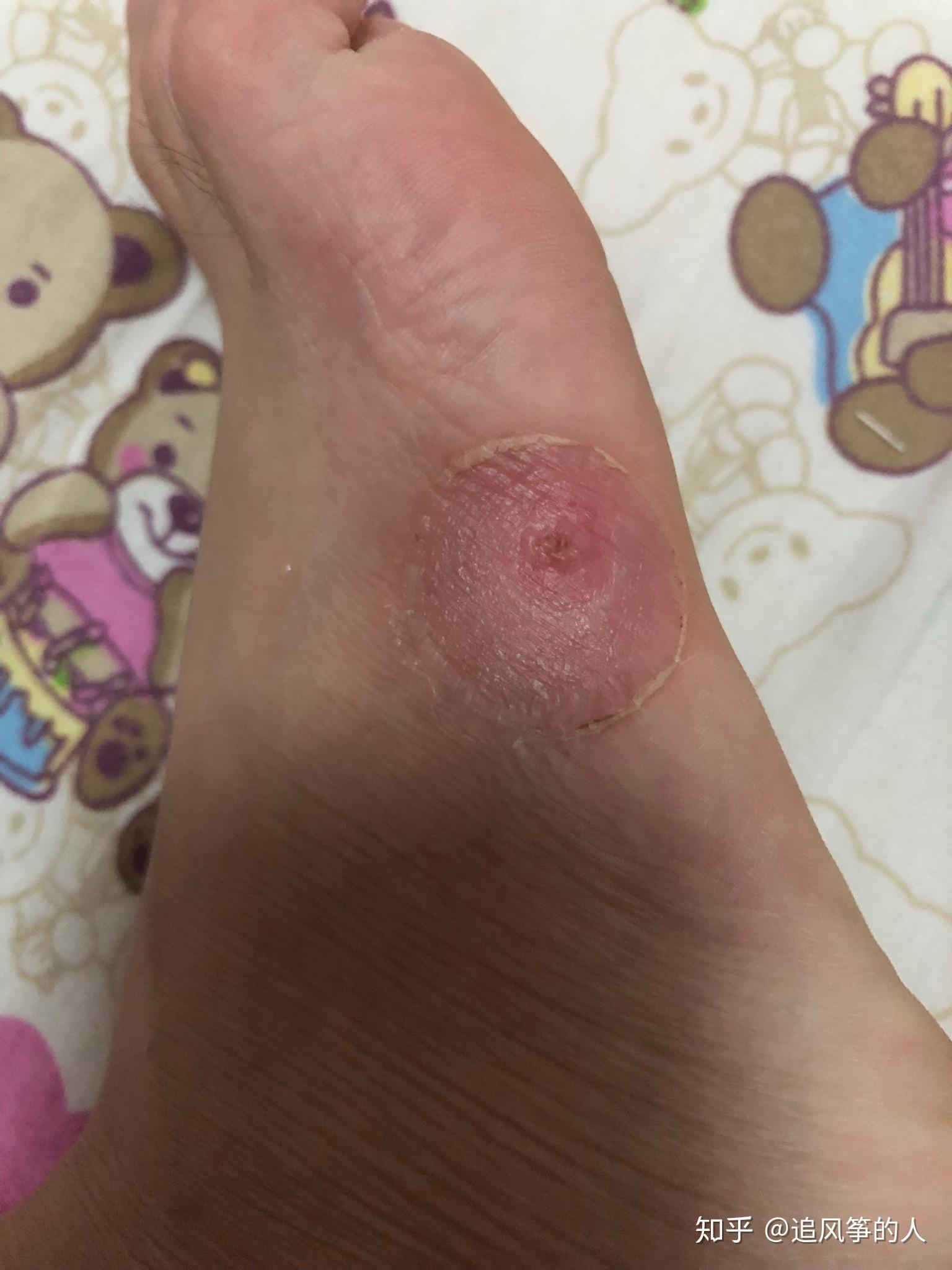 记录治疗寻常疣的日子