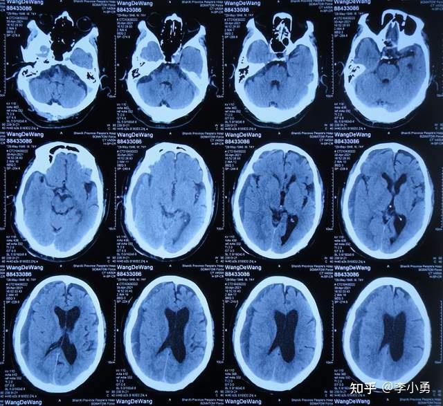 老年正常压力脑积水首次腰大池分流术失败并颅内出血手术后,在多方