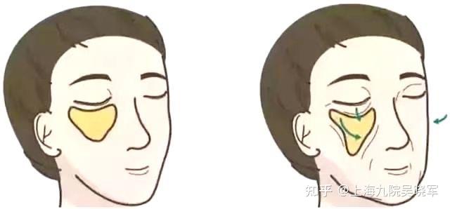 什么是发腮 - 知乎