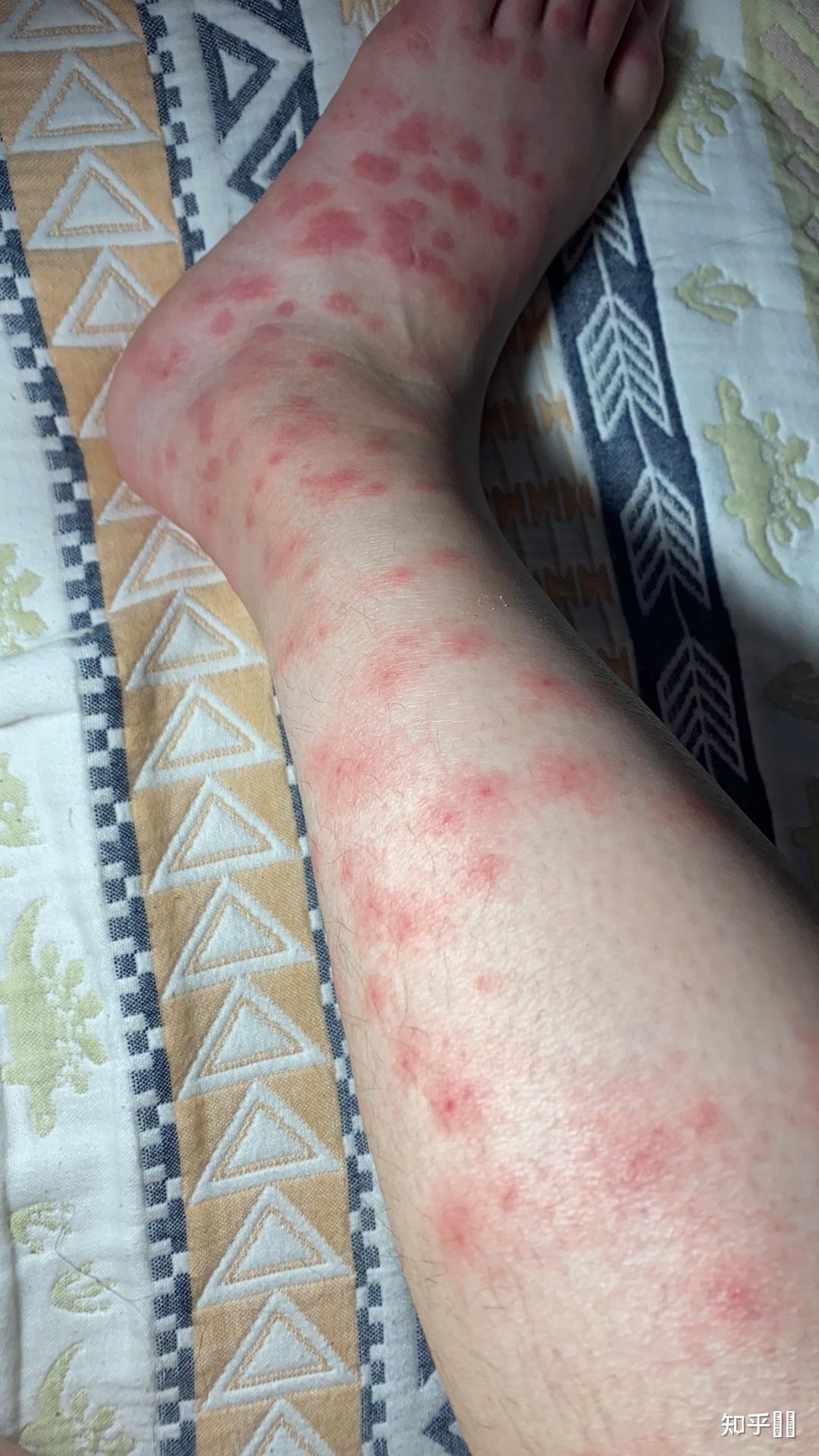 在南方被毒蚊子咬是一种怎样的体验