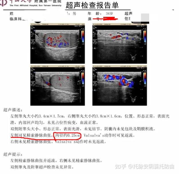 精索静脉曲张手术前后精液质量对比? - 知乎